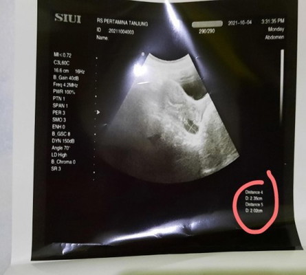 Kantung janin atau bukan ya?