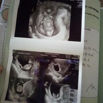 PUSING di Usia kandungan 12w