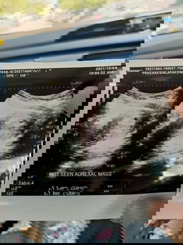 อายุครรภ์ 5 W ของแม่ๆบ้านอื่นมีขนาดเท่าไหร่แล้วคะ