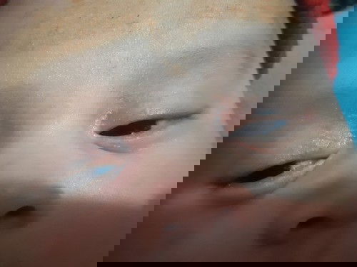 Merah pada bagian mata bayi