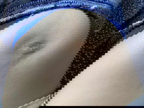 Trị rạn bụng khi mang thai