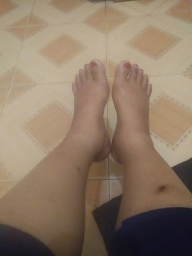 kaki bengkak kalau di bawa duduk atau berdiri ataupun jalan. kalau bawa baring agak berkurang ada