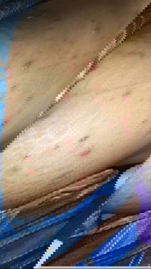 hamil 24 week, terkena cacar