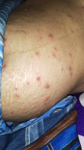 hamil 24 week, terkena cacar