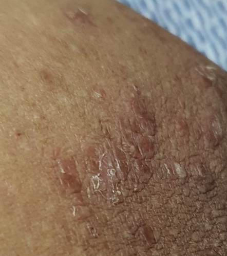 Skin rash or fungi?