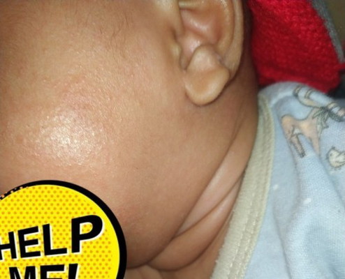 Ruam merah dan bintik merah di kepala dan wajah bayi umur 2 bulan minta saran cream