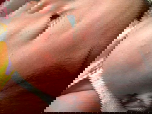 หน้าขึ้นผื่นแดงๆ