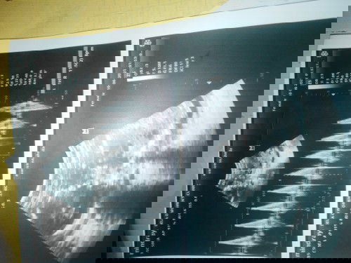 Weight ni baby sa ultrasound