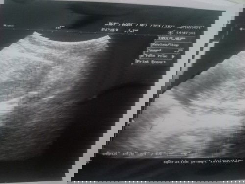 Kehamilan 4-5 minggu