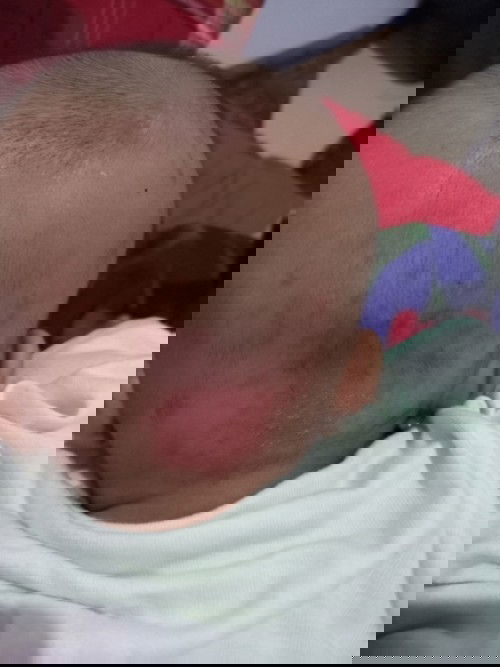 Gatel gatel pada bayi