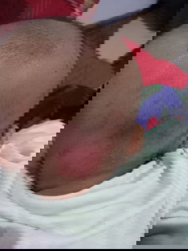 Gatel gatel pada bayi