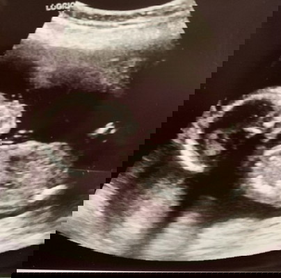 Ada mommy’s yg da scan baby 17weeks ke ? jantina pn da bleh nampak ? Mak cakap baby besar, tkot salah kira 🤭