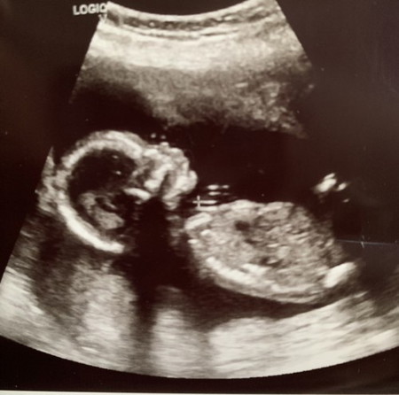 Ada mommy’s yg da scan baby 17weeks ke ? jantina pn da bleh nampak ? Mak cakap baby besar, tkot salah kira 🤭