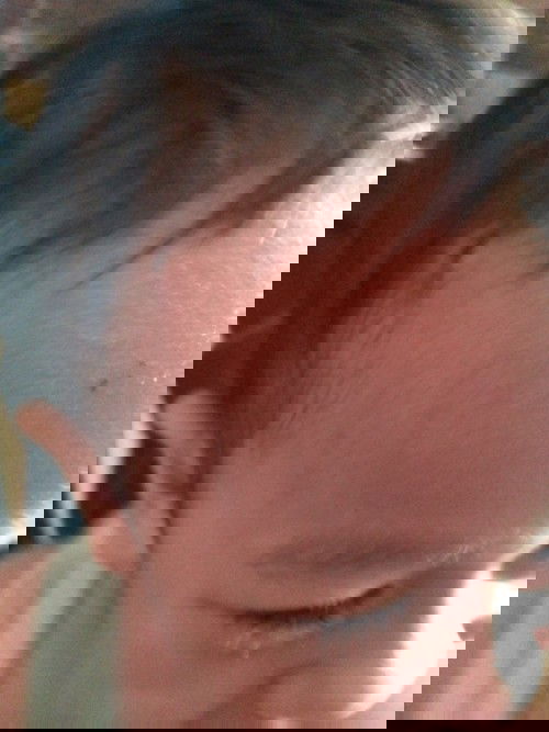 Bisul tumbuh trus.. Jadi takut. Penyebab nya apa ya?