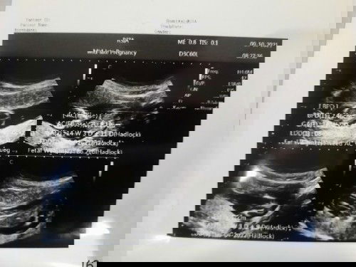 Usg 14minggu, bayi posisi sujud