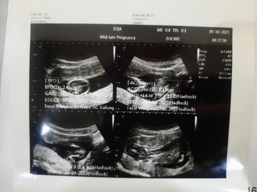 Usg 14minggu, bayi posisi sujud