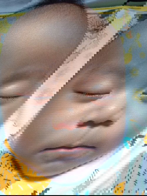 Bercak putih diwajah bayi