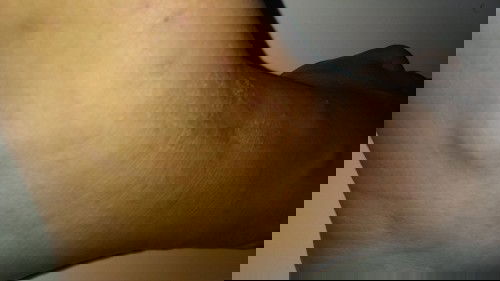 Gatal gatal saat hamil