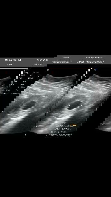 Wkt pertama usg hsl usgnya qo cm kantongnya z yg nampak y dok,apa yg haris saya lakukan y dok?