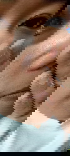 Skin problem
