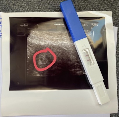 ท้อง5สัปดาห์5วัน