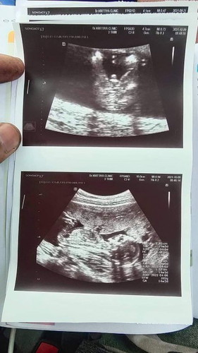 มีแม่ๆคนไหนรู้เพศน้องกันแล้วบ้างคะ 14W3D