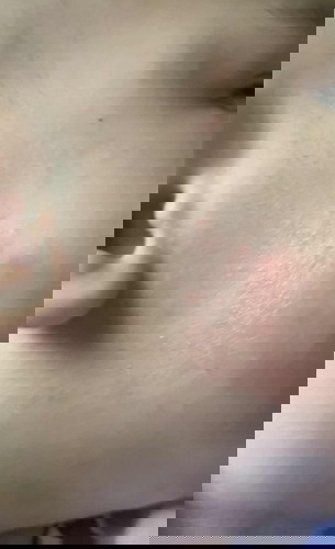 Red Spot on face