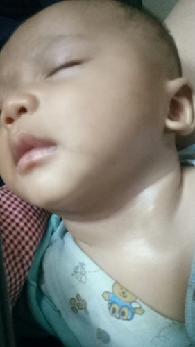 Apakah ada anak bunda yang mengalami Tortikolis?