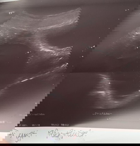 Cyst Besar Pada Awal kehamilan