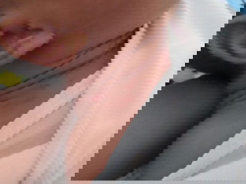 Rashes on neck