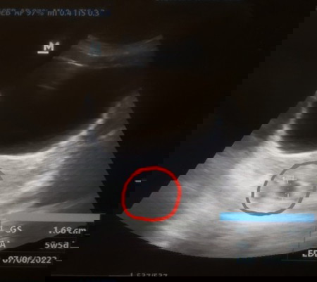 Usia kehamilan dari hasil USG berbeda dengan perhitungan HPHT