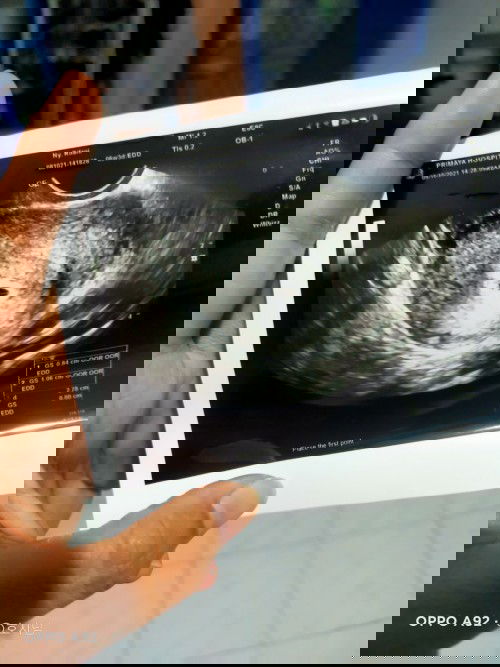 Apakah ini sudah ada janinnya? Atau masih kantung?