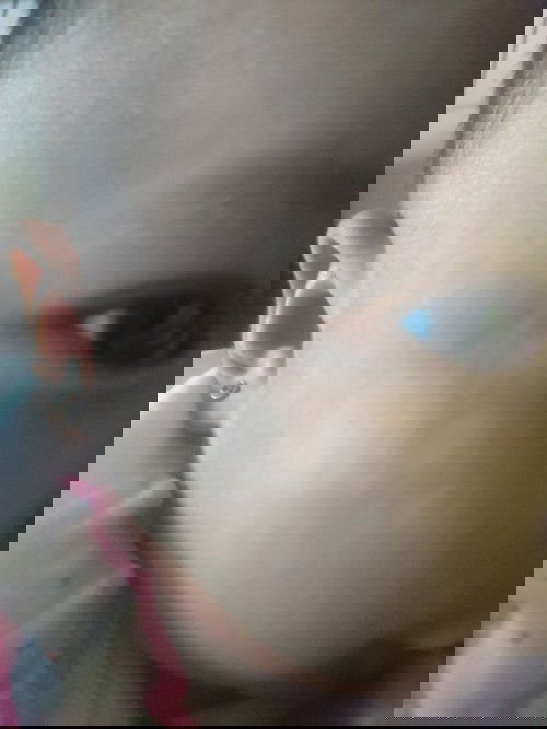 Bercak putih di kulit bayi