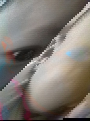 Bercak putih di kulit bayi