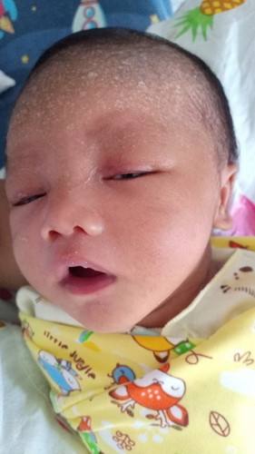 Bun mau tanya ini masih umur seminggu an, tp jidatnya full bruntus berair, pakai secang bisa ga ya?