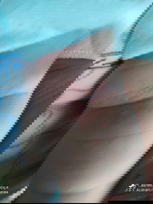 bintik merah pada kulit baby newborn