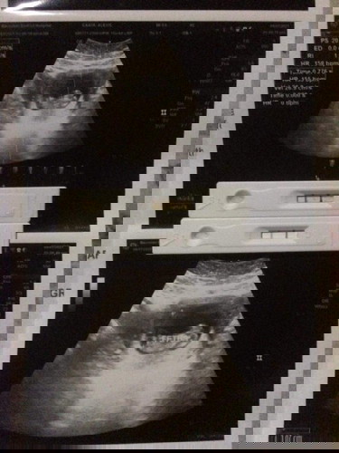 Gender ultrasound