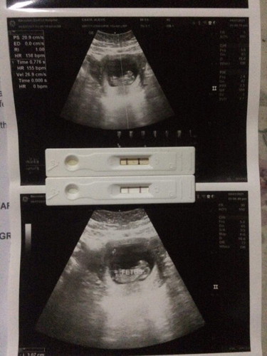 Gender ultrasound