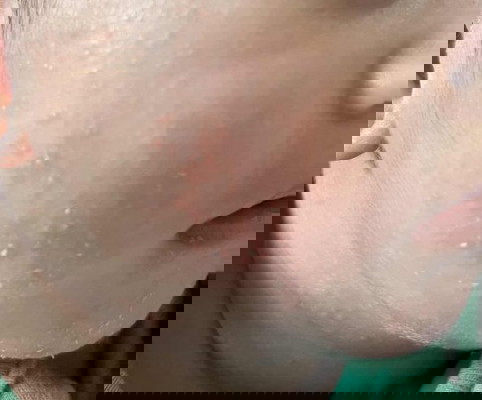 what causes this skin condition?