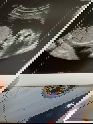 Cant determine gender from ultŕasound