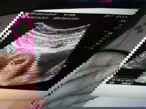 Usg beda 4 minggu dgn hpht