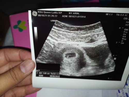 Usg beda 4 minggu dgn hpht