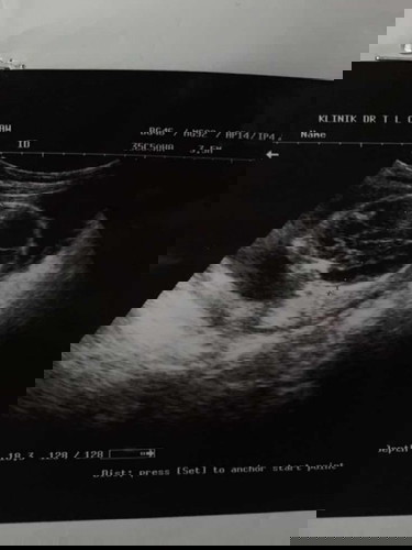 Alhamdulillah pregnant