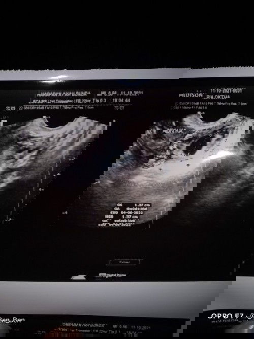 Hasil usg perkiraan 5/6week