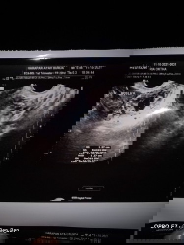 Hasil usg perkiraan 5/6week