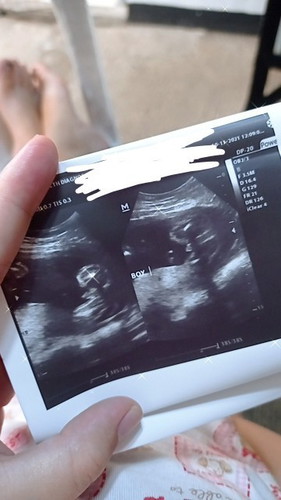 Gender baby