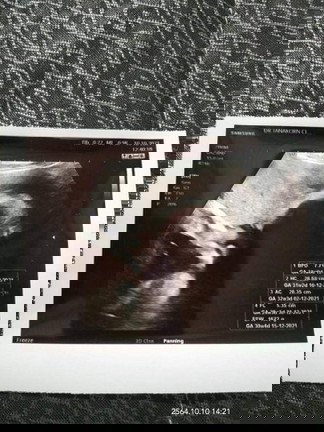 ทำไมใบซาว ที่หมอซาว กับ กำหนดคลอดที่หมอบอกทำไมไม่ตรงกันค่ะ แม่ๆคนไหนเป็นแบบนี้บ้างค่ะ