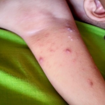 Assalamualaikum bunda" , maaf seblmnya mau nanya klo kulit bayi seperti nie kira" obtnya mke apa ya