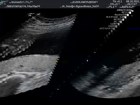 bunn USG kaya gini apa udah pasti akurat?