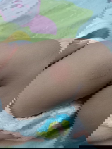 ผื่นแดงคัน ตุ่มแดง